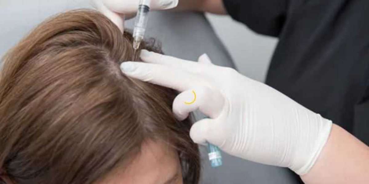 Best Prp Hair Restoration Los Angeles