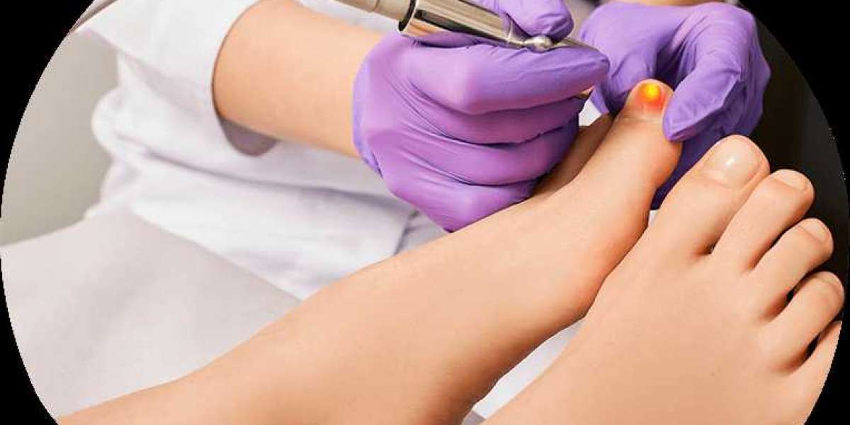 Melbourne Nail Laser Clinic: Revolutionizing Podiatric Care with Lunula Laser and PinPointe Foot Laser
