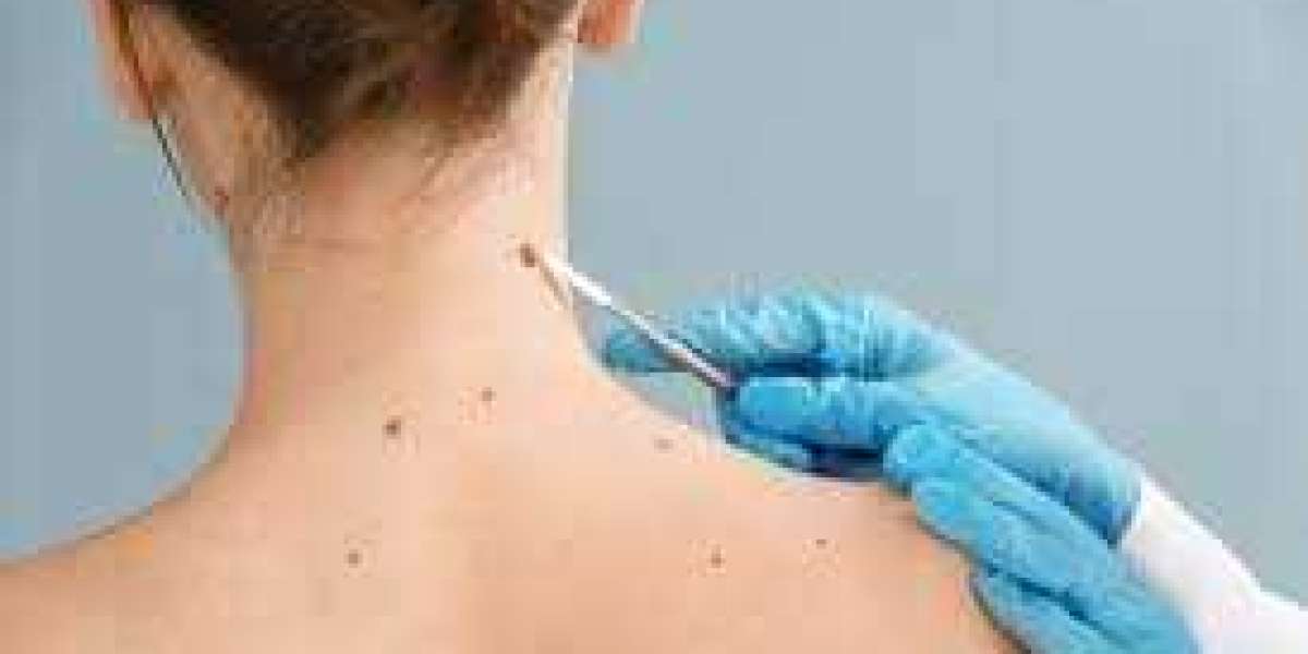Skin Tag Removal Clinic in Noida