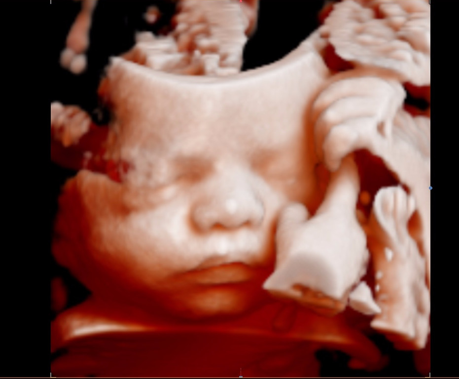 Premium Early Gender Scan - 5D/4D/3D Baby Ultrasound Melbourne